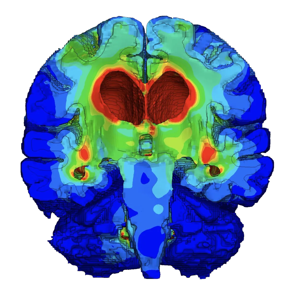 A coronal finite element brain model coloured by simulated strain, showing peak strain concentrated around the enlarged ventricles in idiopathic normal pressure hydrocephalus.