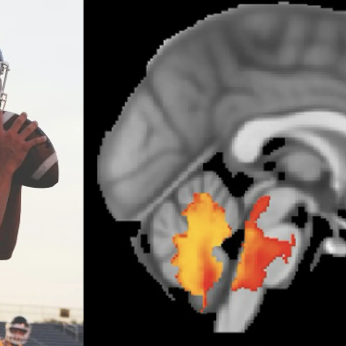 Brain model highlighting the brainstem regions whose strain explains loss of consciousness.